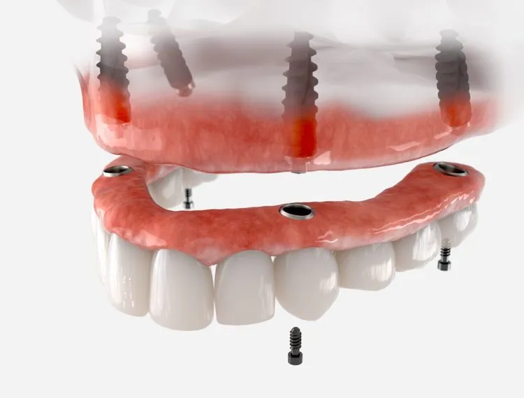 Dentures vs. Implants: Which Is Right for You? in Lansing, MI